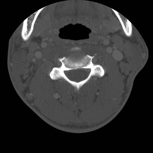 Cervical Pott disease (Radiopaedia 20374-20286 Axial bone window 64).jpg