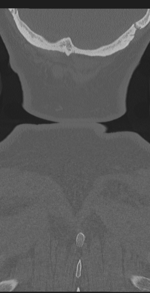 Cervical canal stenosis due to ossification of the posterior longitudinal ligament (Radiopaedia 47260-51823 Coronal bone window 72).png