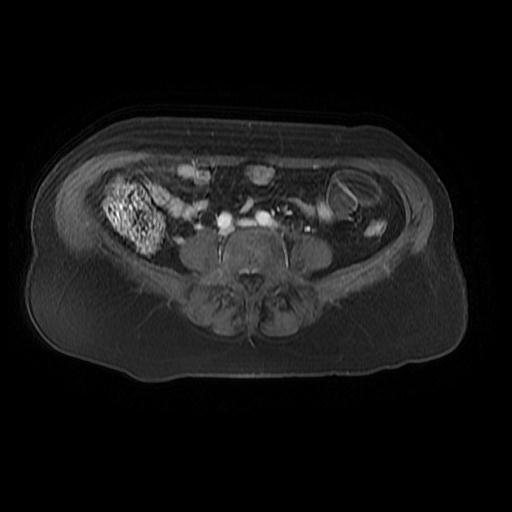 File:Cervical carcinoma (Radiopaedia 67644-77047 Axial T1 C+ fat sat 1).jpg