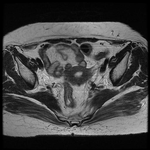 File:Cervical carcinoma (Radiopaedia 70924-81132 Axial T2 5).jpg