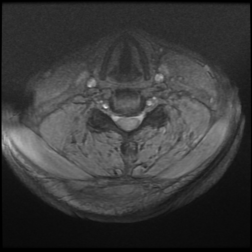 File:Cervical disc extrusion (Radiopaedia 59074-66364 F 31).jpg