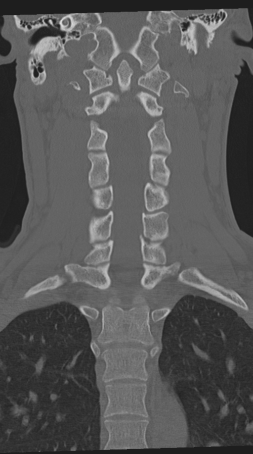Cervical intercalary bone (Radiopaedia 35211-36748 Coronal bone window 42).png