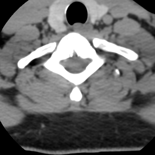 File:Cervical schwannoma (Radiopaedia 57979-64974 Axial non-contrast 54).png