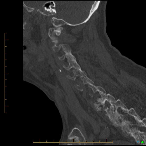 Cervical spine fracture - ankylosing spondylitis (Radiopaedia 76835-88706 Sagittal bone window 36).jpg