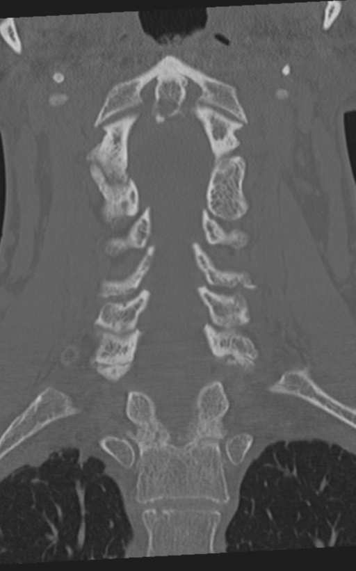 Cervical spine fractures with vertebral artery dissection (Radiopaedia 53296-59268 Coronal bone window 35).png