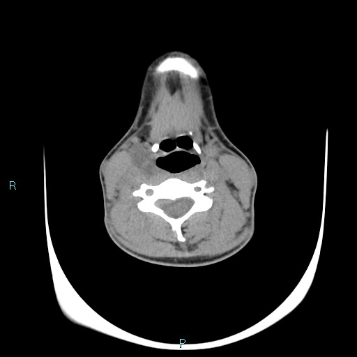 Cervical thymic cyst (Radiopaedia 88632-105335 Axial non-contrast 62).jpg