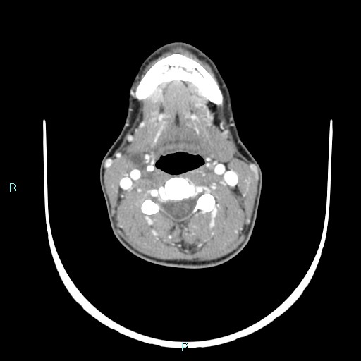 Cervical thymic cyst (Radiopaedia 88632-105335 B 66).jpg