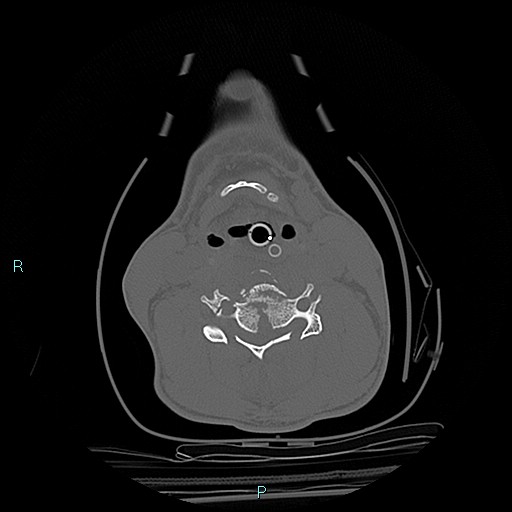 File:Cervical vertebral burst fracture (Radiopaedia 37420-39258 Axial bone window 26).jpg