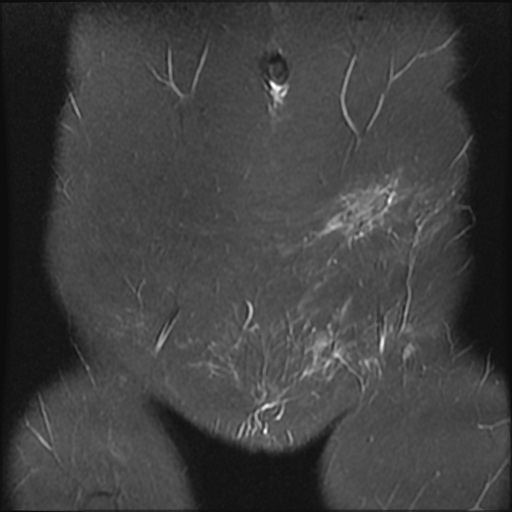 File:Cesarian section scar endometriosis (Radiopaedia 66520-75799 Coronal STIR 2).jpg