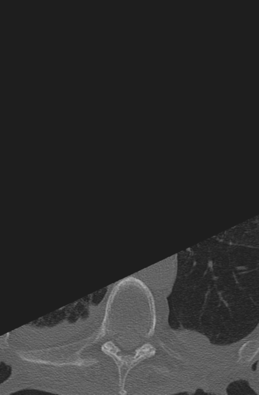 Chalk stick fracture (Radiopaedia 57948-64928 Axial bone window 77).png