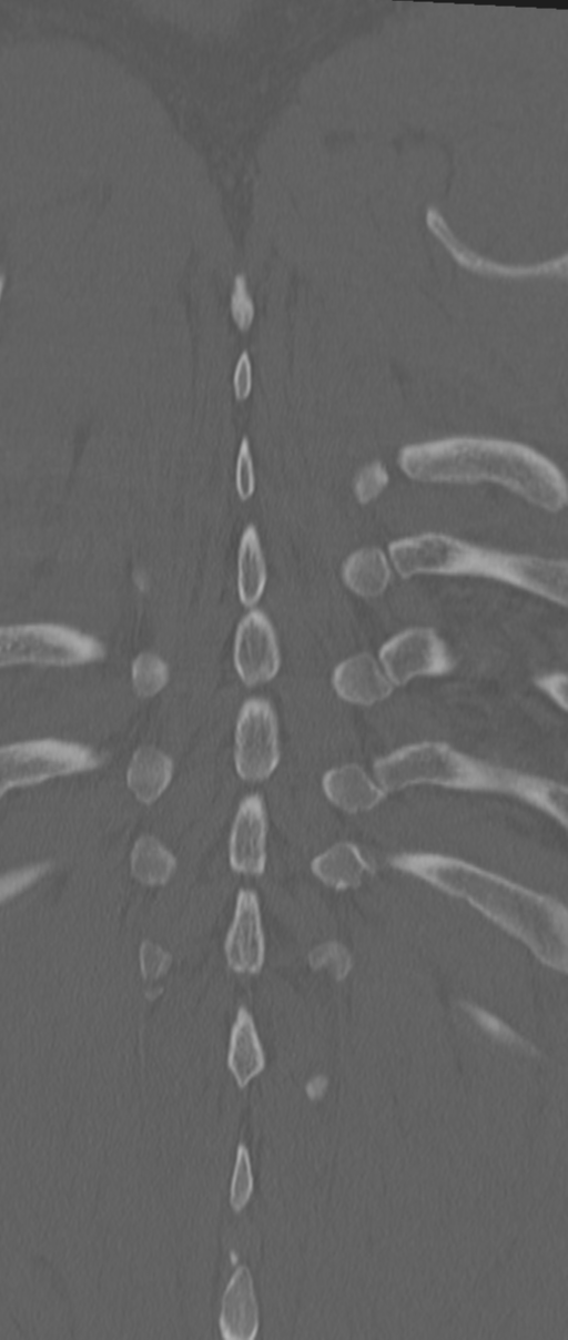 Chance fracture (Radiopaedia 33854-35020 Coronal bone window 75).png