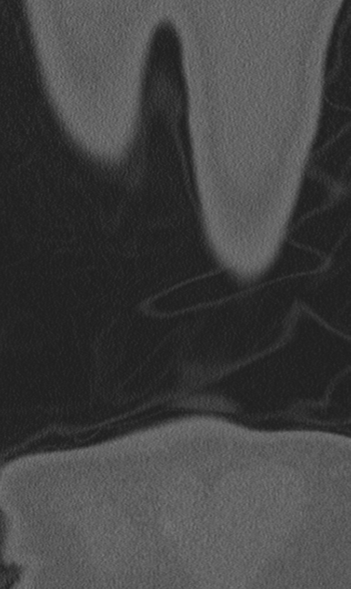 Chance fracture (Radiopaedia 40360-42912 Coronal bone window 75).png