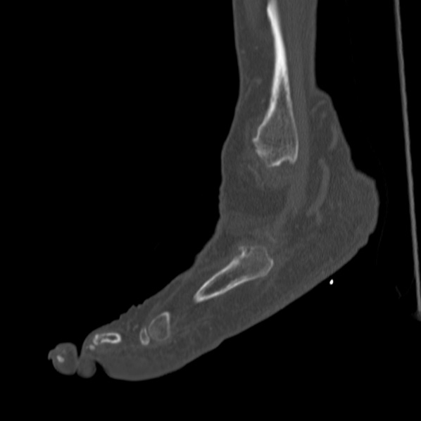 Charcot joint (Radiopaedia 36629-38194 Sagittal bone window 28).jpg