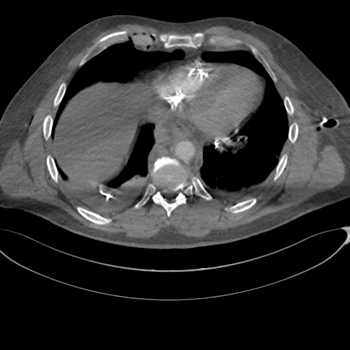 File:Chest multitrauma - aortic injury (Radiopaedia 34708-36147 A 212).png