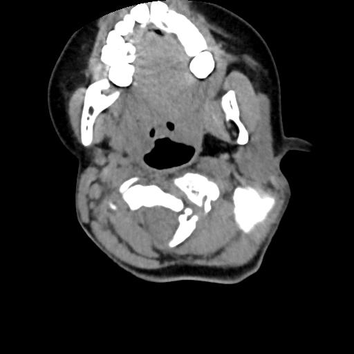 Chiari I with syrinx and skull base anomalies (Radiopaedia 89444-106412 Axial non-contrast 56).jpg
