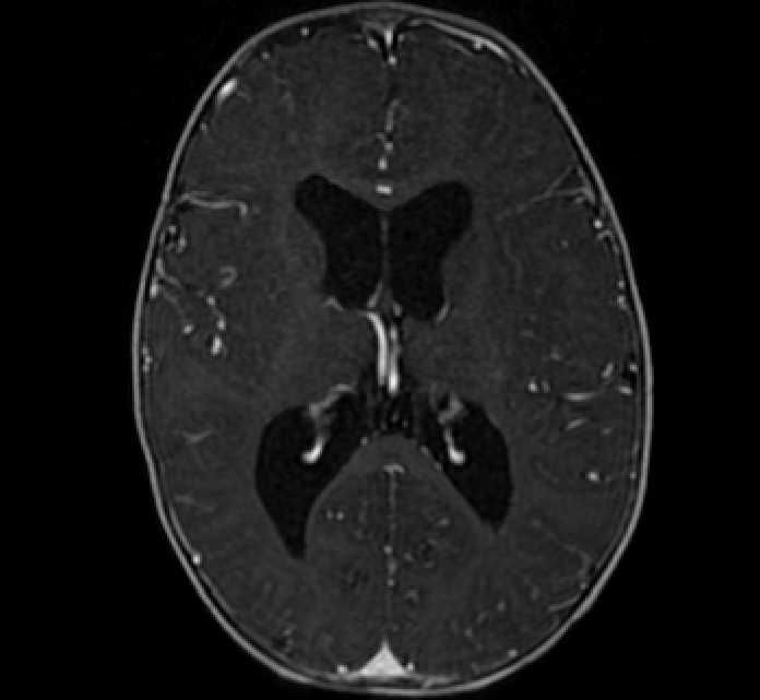 Chiasmatic-hypothalamic glioma (Radiopaedia 90079-107252 Axial T1 C+ 50).jpg