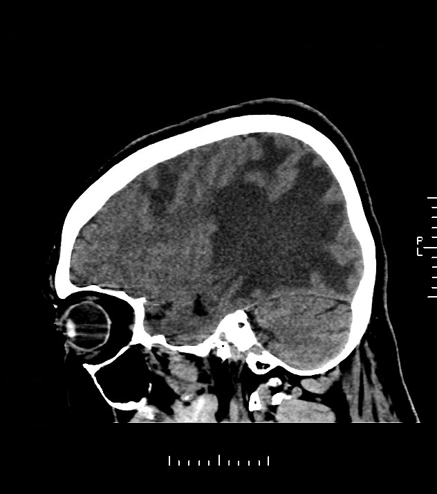 Cholangiocarcinoma with cerebral metastases (Radiopaedia 83519-98628 C 15).jpg