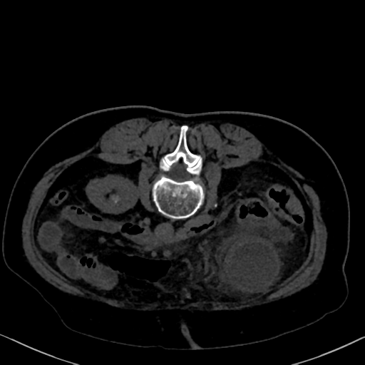 File:Cholecystitis - obstructive choledocholitiasis (CT intravenous cholangiography) (Radiopaedia 43966-47479 Axial 48).png