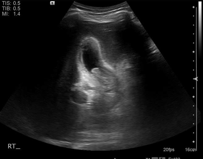 File:Cholecystitis - perforated gallbladder (Radiopaedia 57038-63913 A 28).jpg