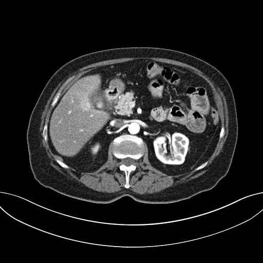 Cholecystoduodenal fistula due to calculous cholecystitis with gallstone migration (Radiopaedia 86875-103077 A 27).jpg