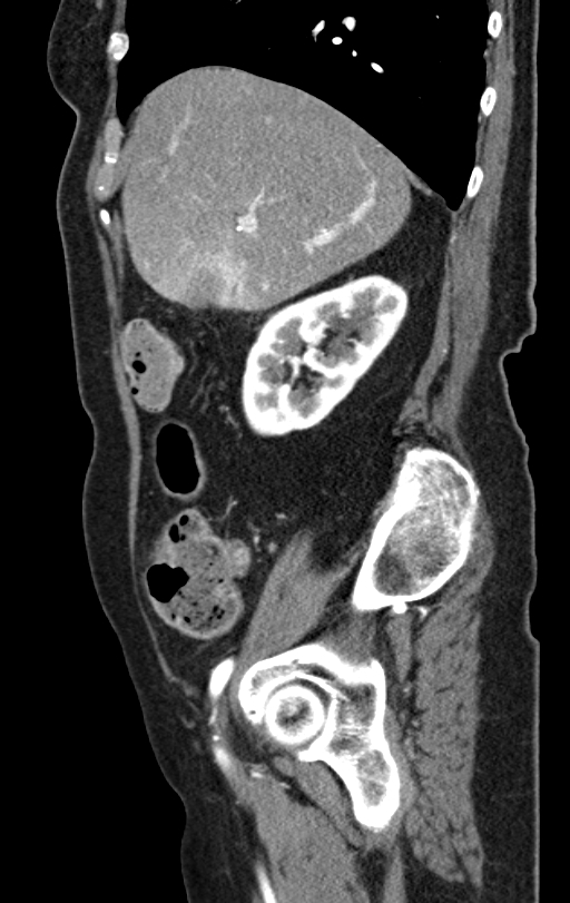 Cholecystoduodenal fistula due to calculous cholecystitis with gallstone migration (Radiopaedia 86875-103077 C 45).jpg