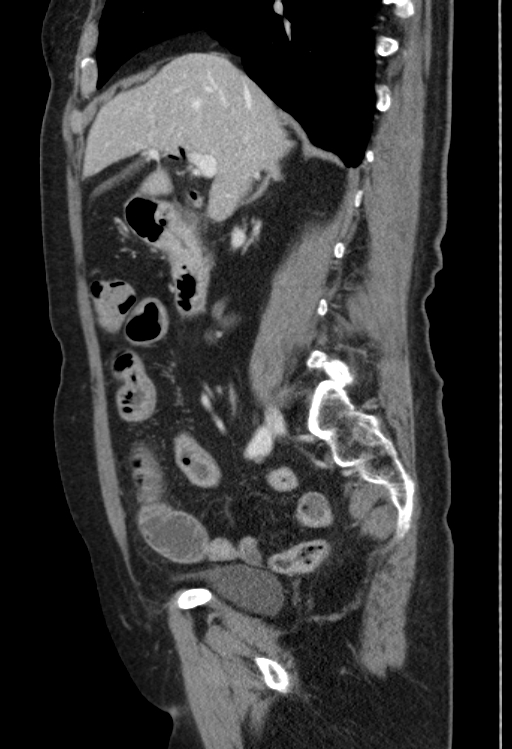 Cholecystoduodenal fistula due to calculous cholecystitis with gallstone migration (Radiopaedia 86875-103077 F 37).jpg