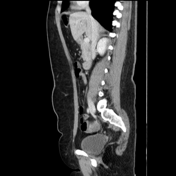 Choledocholithiasis on CT and MRI (Radiopaedia 24825-25087 D 28).jpg