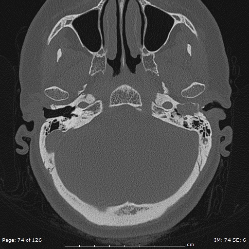 Cholesteatoma - external auditory canal (Radiopaedia 88452-105096 Axial bone window 37).jpg