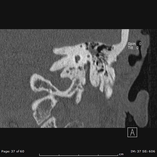 Cholesteatoma - external auditory canal (Radiopaedia 88452-105096 Coronal bone window 37).jpg