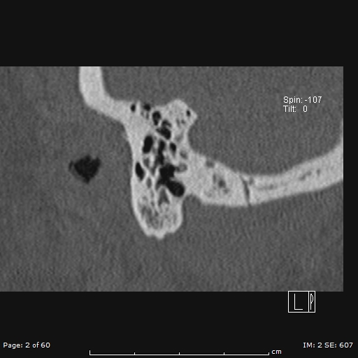 File:Cholesteatoma - external auditory canal (Radiopaedia 88452-105096 Sagittal bone window 2).jpg