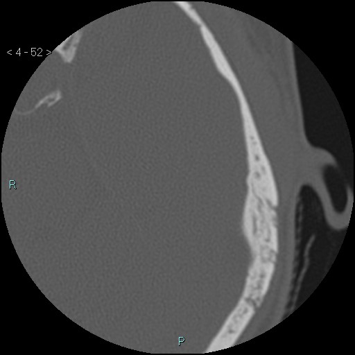 File:Cholesterol granuloma of the petrous apex (Radiopaedia 64358-73141 Axial bone window 25).jpg