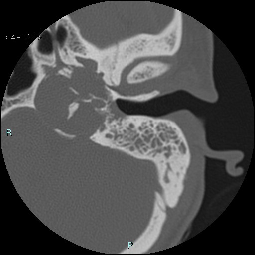 File:Cholesterol granuloma of the petrous apex (Radiopaedia 64358-73141 Axial bone window 58).jpg