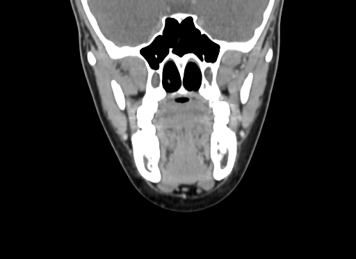 Chondroblastic osteosarcoma (Radiopaedia 67363-76741 D 48).jpg