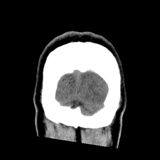 File:Chondrosarcoma - sphenoid wing (Radiopaedia 58259-67828 Coronal non-contrast 32).jpg