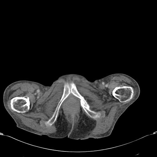File:Chondrosarcoma of the spine (Radiopaedia 49871-55143 A 68).jpg