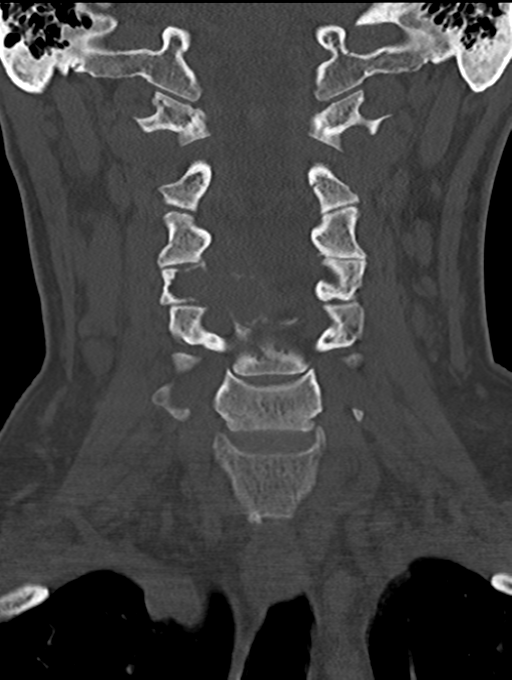 Chordoma (C4 vertebra) (Radiopaedia 47561-52188 Coronal bone window 22).png