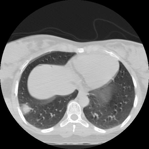 File:Choriocarcinoma of ovary with cerebral and pulmonary metastases (Radiopaedia 25983-26119 Axial lung window 21).jpg