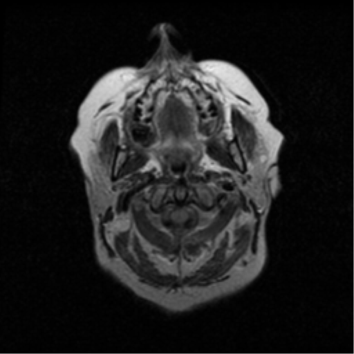 File:Choroid plexus papilloma (Radiopaedia 33040-34052 Axial FLAIR 1).png