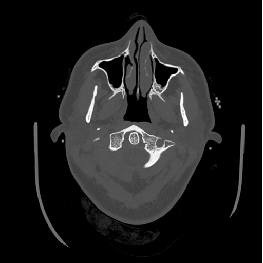 Choroid plexus papilloma extending into the cerebellopontine angle cistern (Radiopaedia 85941-101833 Axial bone window 10).png