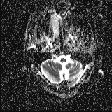 Choroid plexus xanthogranuloma - unilateral (Radiopaedia 85632-101393 Axial ADC 6).jpg