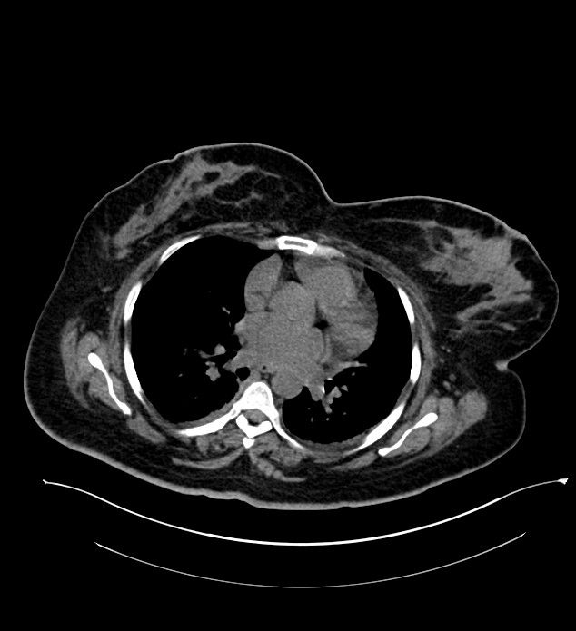 Chromophobe renal cell carcinoma (Radiopaedia 84239-99519 Axial non-contrast 7).jpg