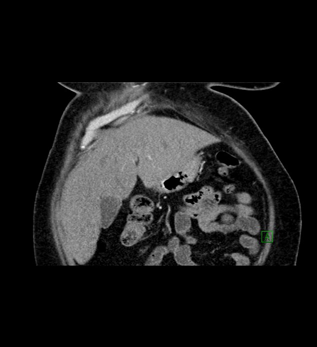 Chromophobe renal cell carcinoma (Radiopaedia 84239-99519 C 20).jpg