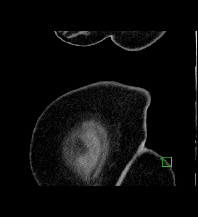 Chromophobe renal cell carcinoma (Radiopaedia 84239-99519 D 1).jpg
