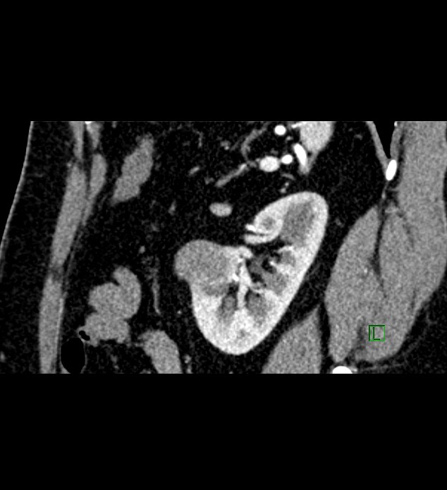 Chromophobe renal cell carcinoma (Radiopaedia 84286-99573 F 45).jpg