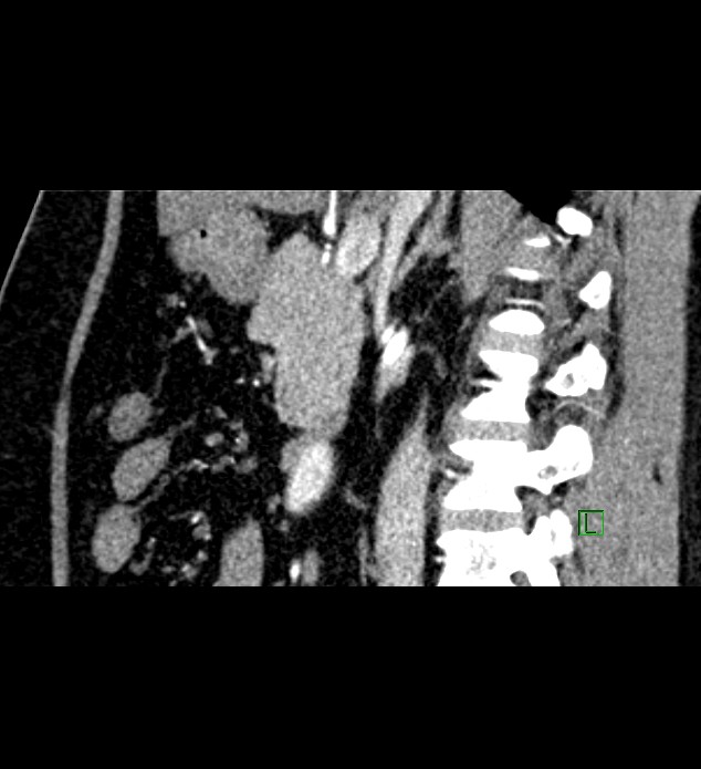 Chromophobe renal cell carcinoma (Radiopaedia 84286-99573 F 97).jpg