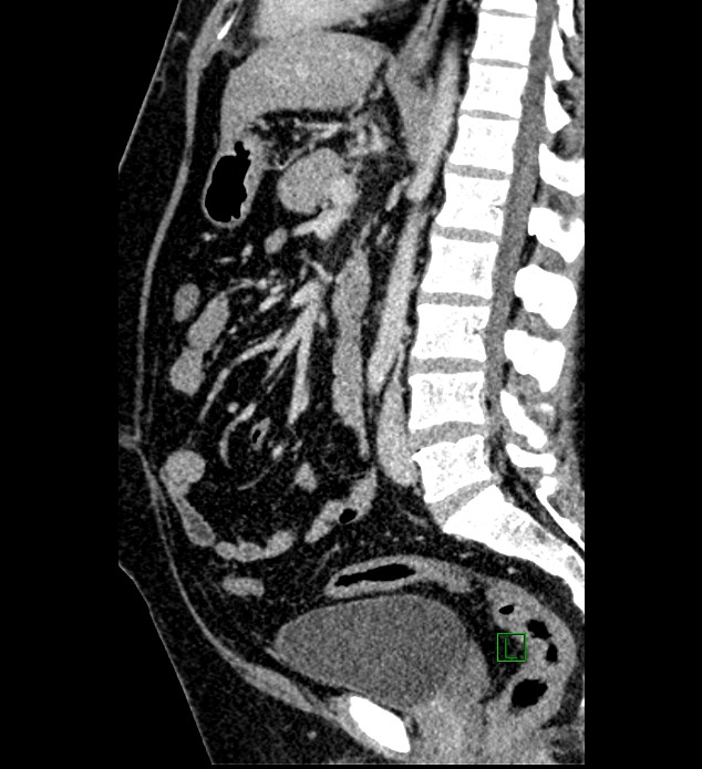 Chromophobe renal cell carcinoma (Radiopaedia 84286-99573 I 89).jpg