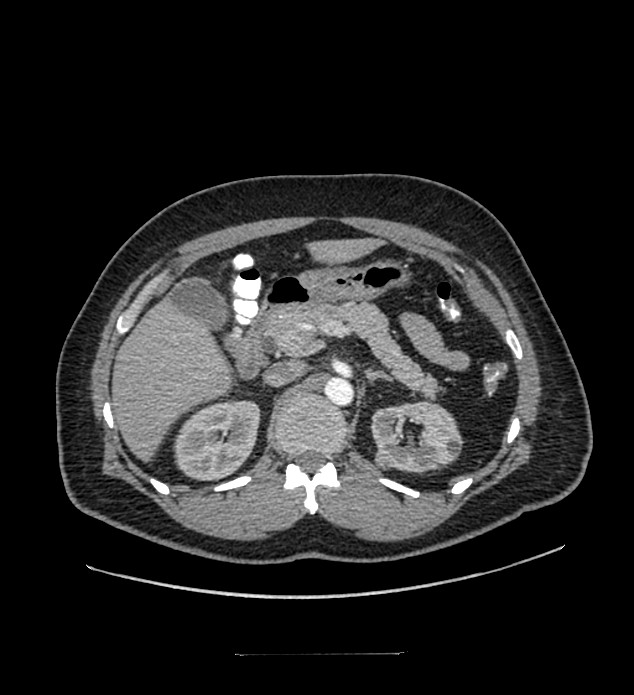 Chromophobe renal cell carcinoma (Radiopaedia 84337-99644 B 32).jpg
