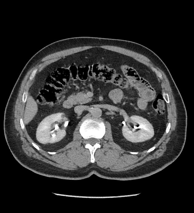 Chromophobe renal cell carcinoma (Radiopaedia 86879-103083 D 56).jpg