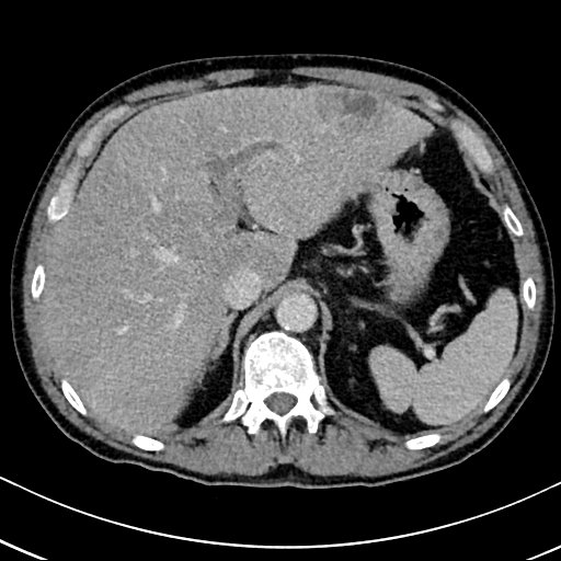 Chronic appendicitis complicated by appendicular abscess, pylephlebitis and liver abscess (Radiopaedia 54483-60700 B 42).jpg