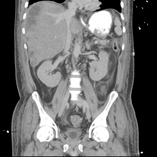 Chronic diverticulitis complicated by hepatic abscess and portal vein thrombosis (Radiopaedia 30301-30938 B 34).jpg